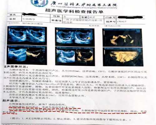 子宫腺肌症不孕